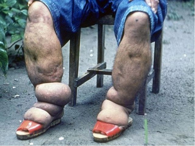 马来西亚男子患病腿肿40年无法正常生活
